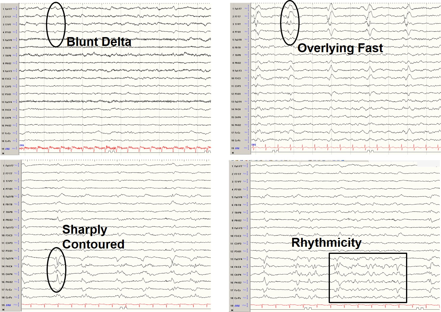 ICU EEG